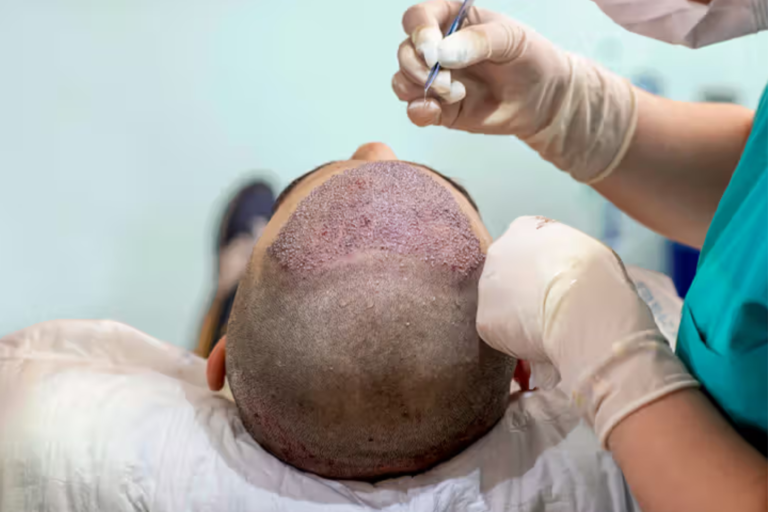 Hairline International - Hair Transplantation